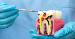 A picture representing root canal treatment